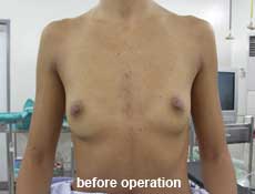 plastic-surgery-breast-augmentation 